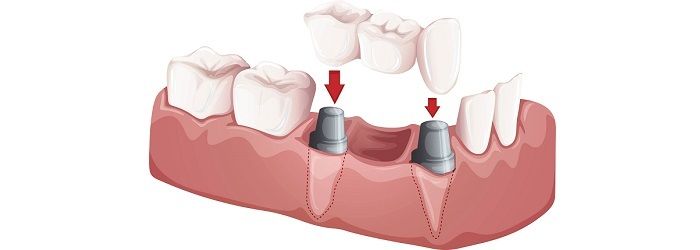 Dental bridge illustration