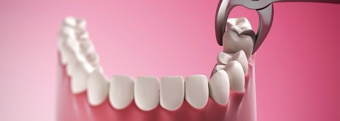 Dental forceps being used to remove tooth