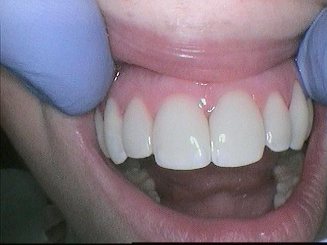 Teeth treated with composite resin for uniform color