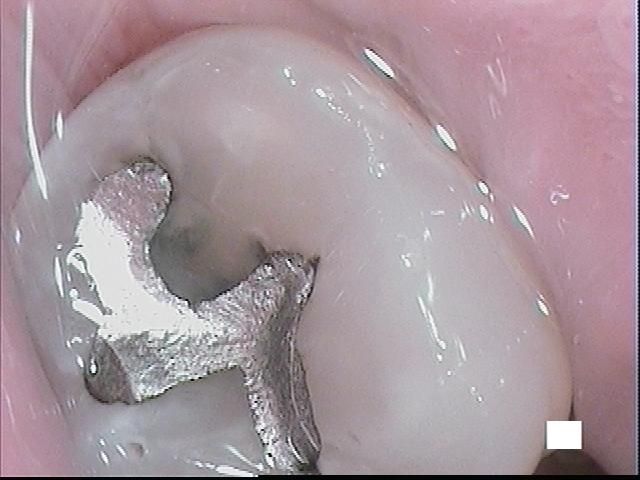 Tooth with decay visible around old amalgam filling