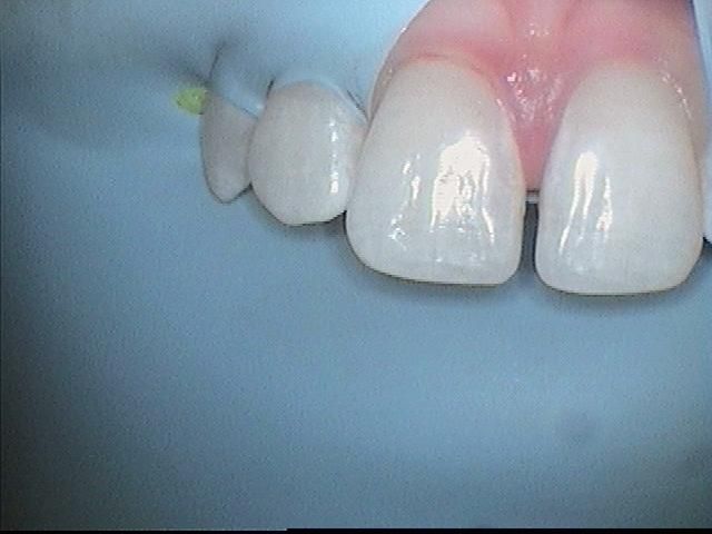 Front teeth with large gap