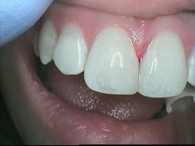 Gap in teeth filled using dental bonding