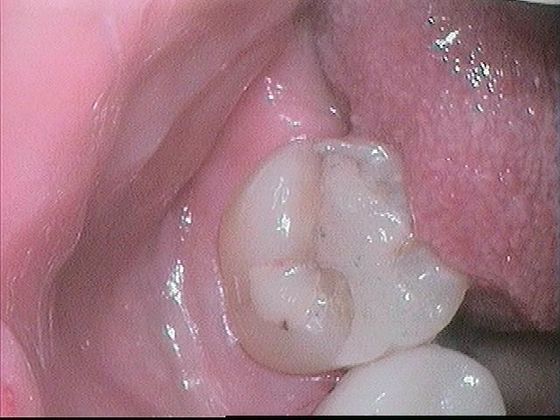 Case 1 before dental crown procedure