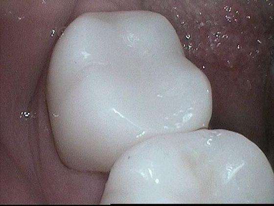 Case 1 after dental crown procedure